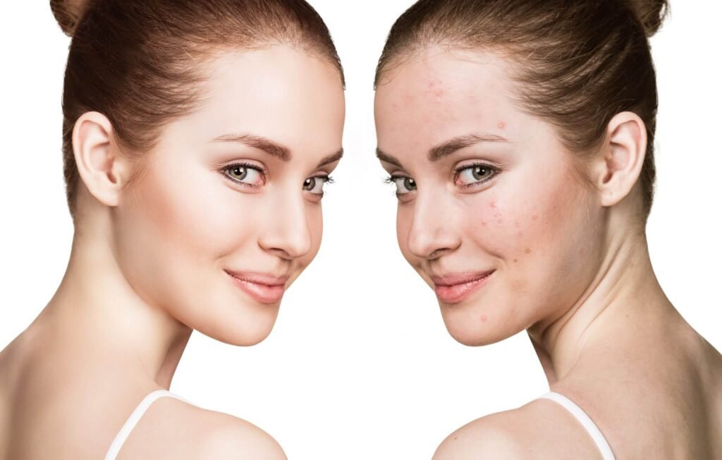 Acne and blemish facial